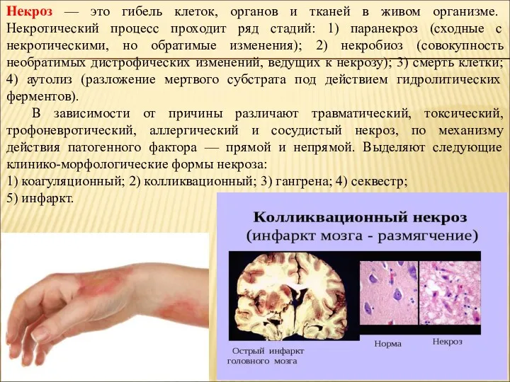 Некроз — это гибель клеток, органов и тканей в живом