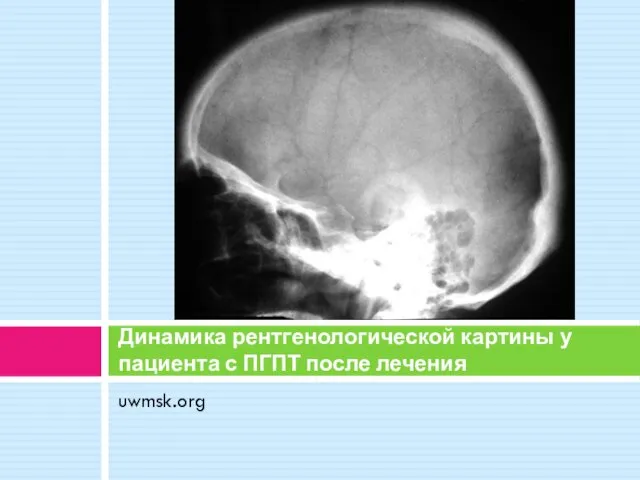 uwmsk.org Динамика рентгенологической картины у пациента с ПГПТ после лечения