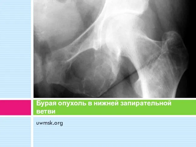 uwmsk.org Бурая опухоль в нижней запирательной ветви