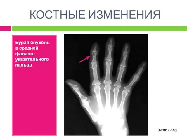 КОСТНЫЕ ИЗМЕНЕНИЯ Бурая опухоль в средней фаланге указательного пальца uwmsk.org