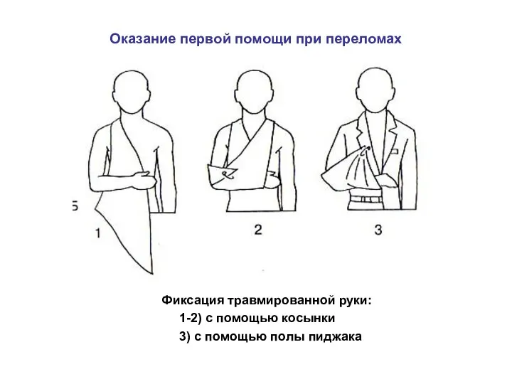 Оказание первой помощи при переломах Фиксация травмированной руки: 1-2) с