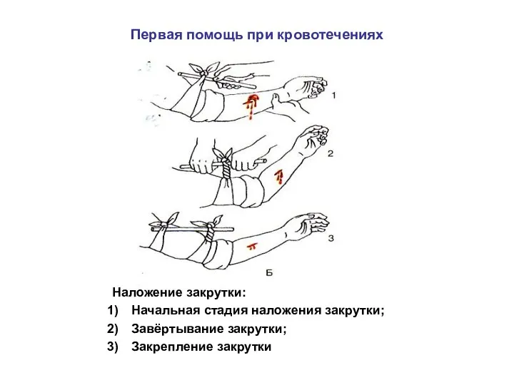 Первая помощь при кровотечениях Наложение закрутки: Начальная стадия наложения закрутки; Завёртывание закрутки; Закрепление закрутки