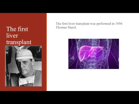 The first liver transplant The first liver transplant was performed in 1956 Thomas Starzl.