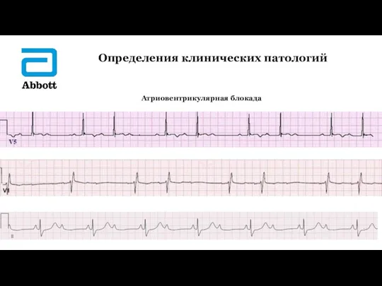 Определения клинических патологий Атриовентрикулярная блокада ▲ ▲