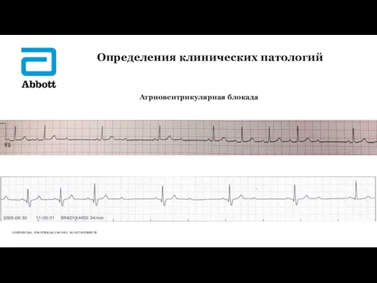 Определения клинических патологий Атриовентрикулярная блокада ▲ ▲