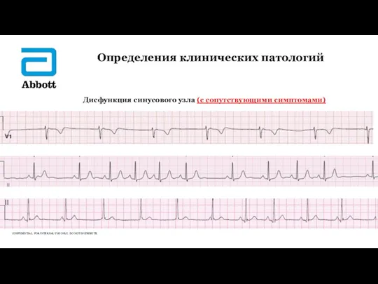 Определения клинических патологий Дисфункция синусового узла (с сопутствующими симптомами) ▲ ▲