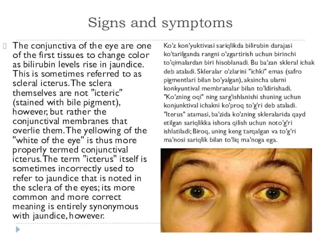 Signs and symptoms The conjunctiva of the eye are one