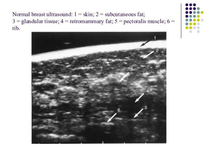 Normal breast ultrasound: 1 = skin; 2 = subcutaneous fat;