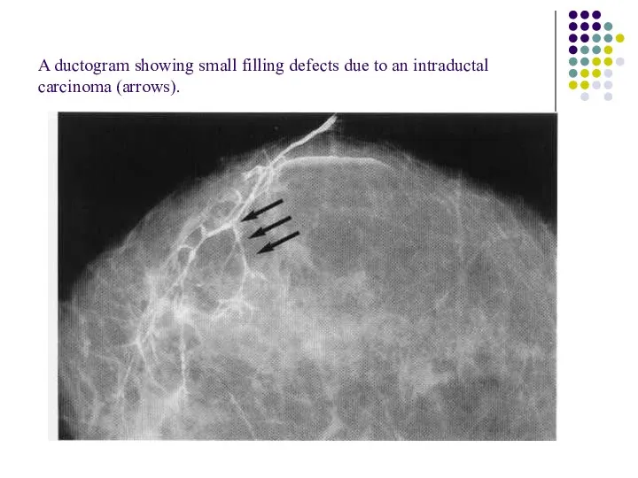 A ductogram showing small filling defects due to an intraductal carcinoma (arrows).