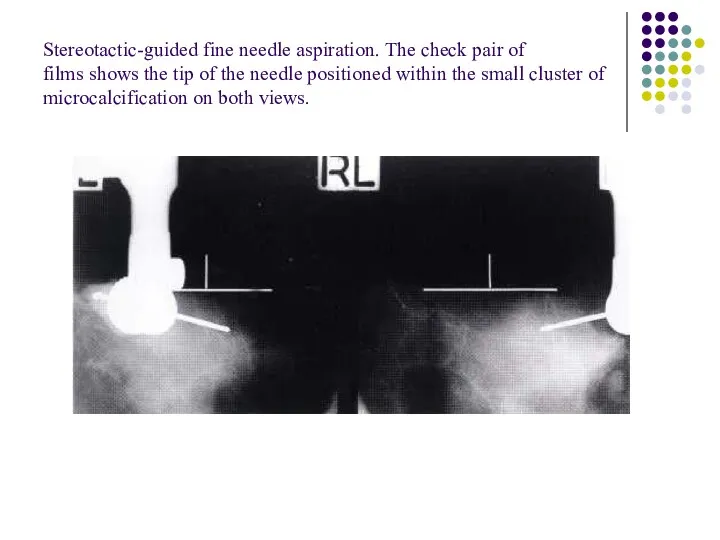 Stereotactic-guided fine needle aspiration. The check pair of films shows