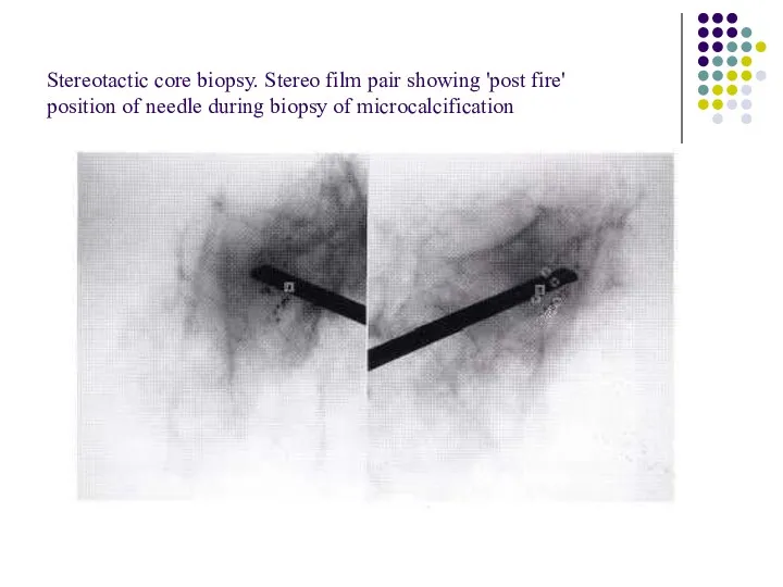 Stereotactic core biopsy. Stereo film pair showing 'post fire' position of needle during biopsy of microcalcification