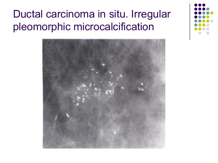 Ductal carcinoma in situ. Irregular pleomorphic microcalcification