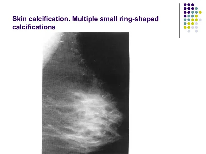 Skin calcification. Multiple small ring-shaped calcifications