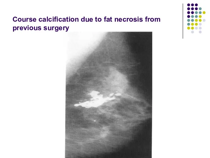 Course calcification due to fat necrosis from previous surgery