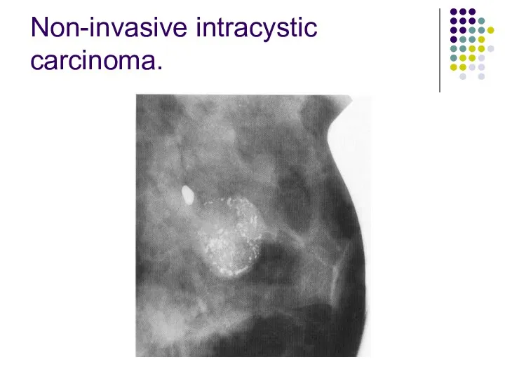 Non-invasive intracystic carcinoma.