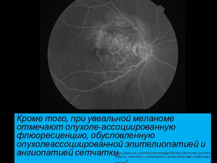 Кроме того, при увеальной меланоме отмечают опухоле-ассоциированную флюоресценцию, обусловленную опухолеассоциированной эпителиопатией и ангиопатией сетчатки. https://www.rmj.ru/articles/oftalmologiya/Ocenka_effektivnosti_brahiterapii_uvealynoy_melanomy_s_ispolyzovaniem_vysokochastotnogo_dupleksnogo_skanirovaniya/