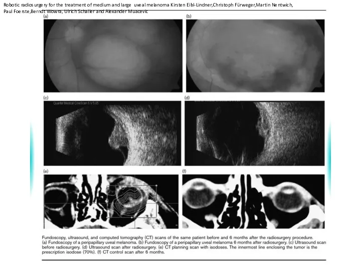 Robotic radiosurgery for the treatment of medium and large uveal