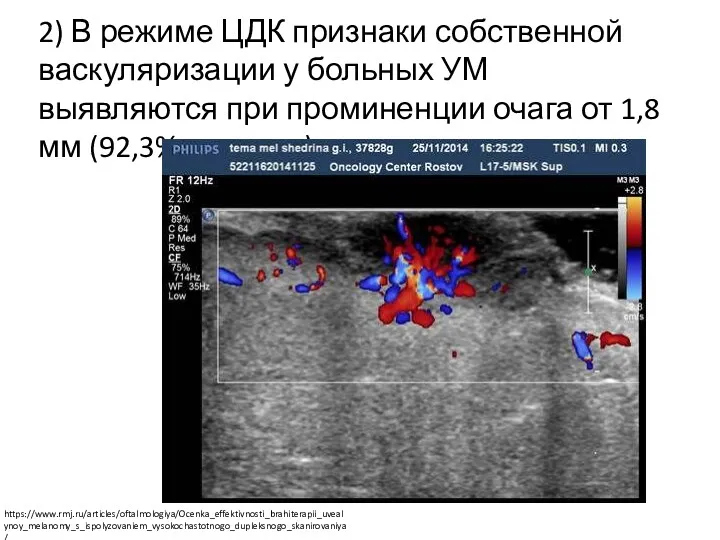 2) В режиме ЦДК признаки собственной васкуляризации у больных УМ