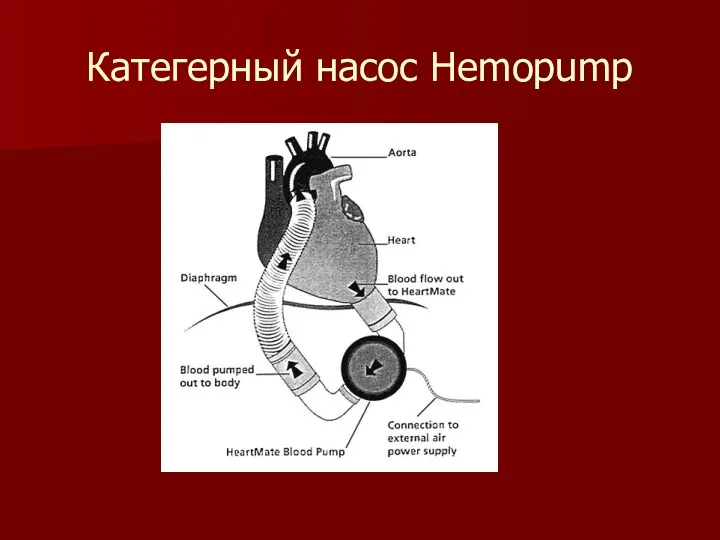 Категерный насос Hemopump