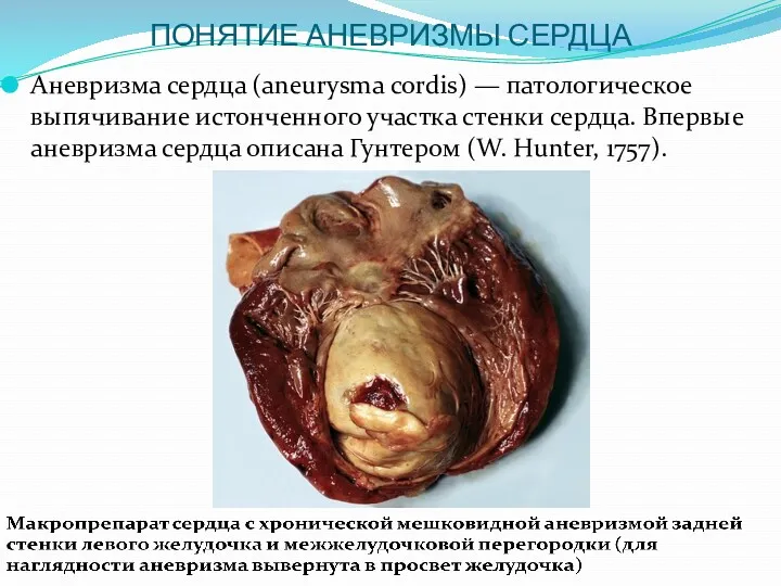 ПОНЯТИЕ АНЕВРИЗМЫ СЕРДЦА Аневризма сердца (aneurysma cordis) — патологическое выпячивание истонченного участка стенки