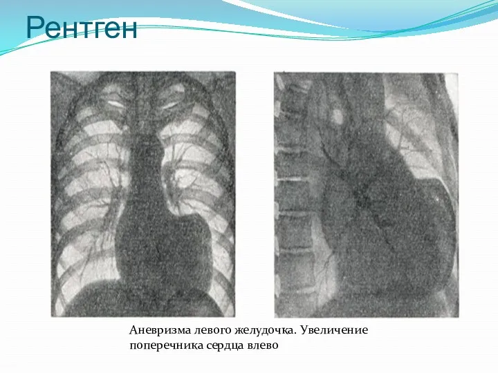 Рентген Аневризма левого желудочка. Увеличение поперечника сердца влево