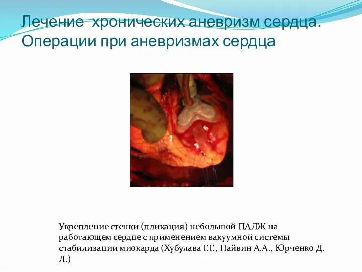 Лечение хронических аневризм сердца. Операции при аневризмах сердца Укрепление стенки