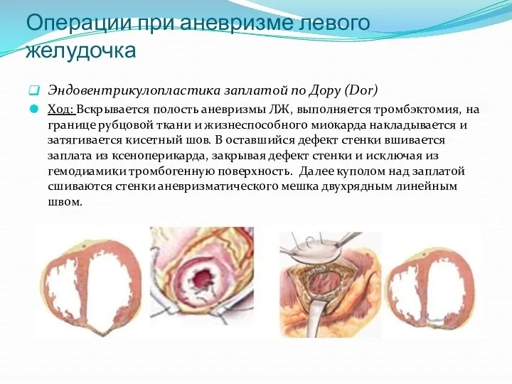 Операции при аневризме левого желудочка Эндовентрикулопластика заплатой по Дору (Dor) Ход: Вскрывается полость