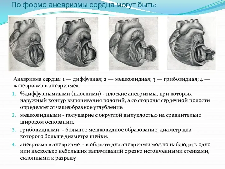 По форме аневризмы сердца могут быть: Аневризма сердца: 1 — диффузная; 2 —