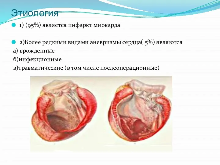 Этиология 1) (95%) является инфаркт миокарда 2)Более редкими видами аневризмы сердца( 5%) являются