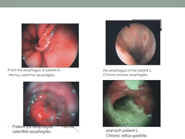 From the esophagus of patient A. Hernia, catarrhal esophagitis. Patient