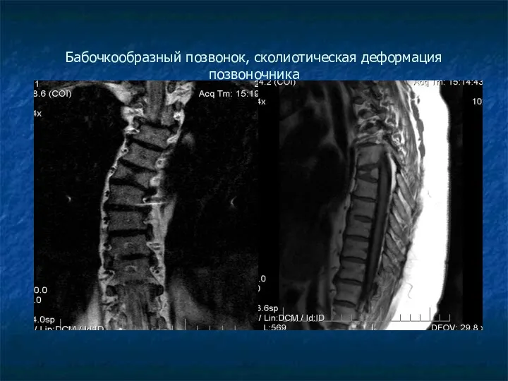 Бабочкообразный позвонок, сколиотическая деформация позвоночника