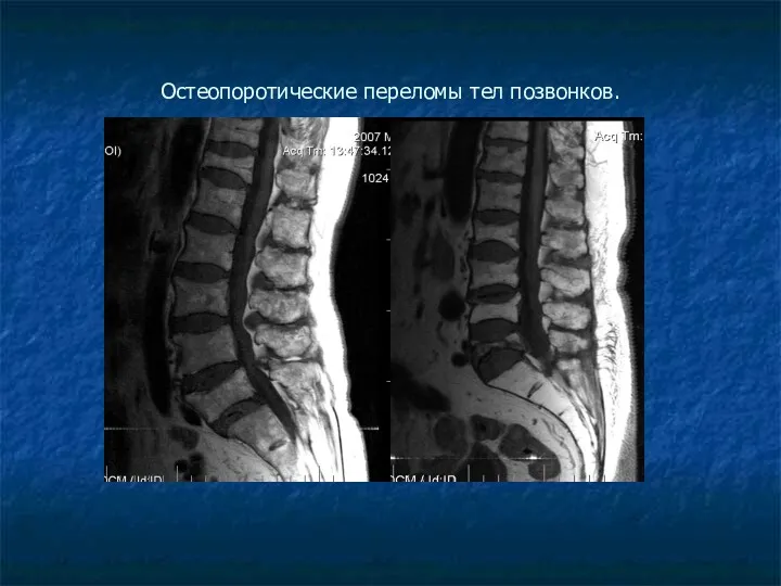 Остеопоротические переломы тел позвонков.
