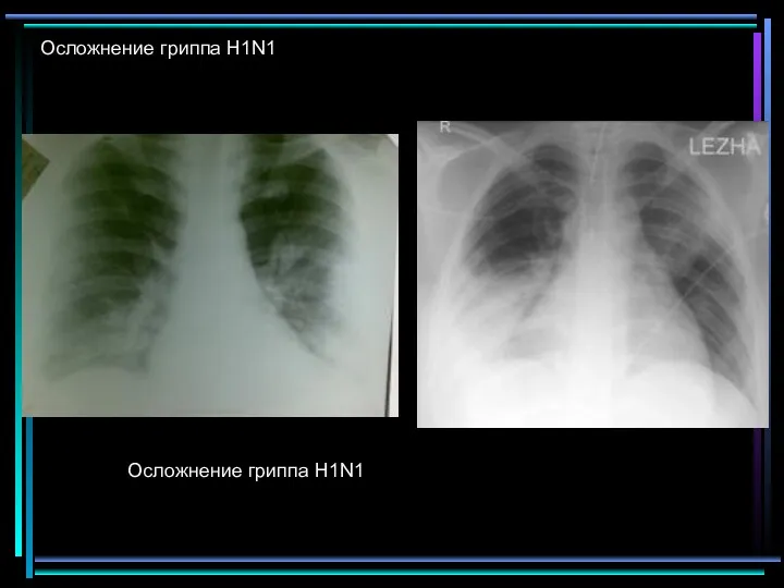 Осложнение гриппа H1N1 Осложнение гриппа H1N1