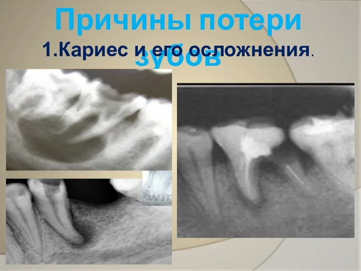 Причины потери зубов 1.Кариес и его осложнения.