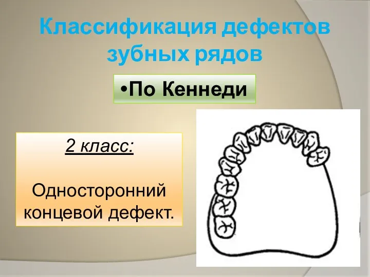 Классификация дефектов зубных рядов По Кеннеди 2 класс: Односторонний концевой дефект.