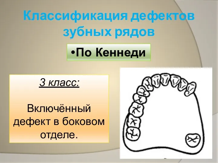 Классификация дефектов зубных рядов По Кеннеди 3 класс: Включённый дефект в боковом отделе.