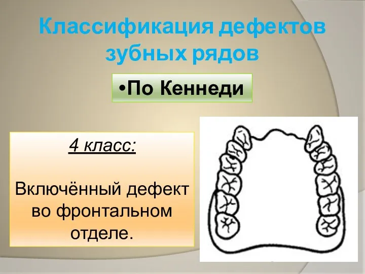 Классификация дефектов зубных рядов По Кеннеди 4 класс: Включённый дефект во фронтальном отделе.