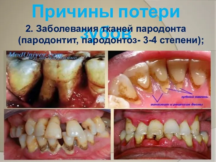Причины потери зубов 2. Заболевания тканей пародонта (пародонтит, пародонтоз- 3-4 степени);