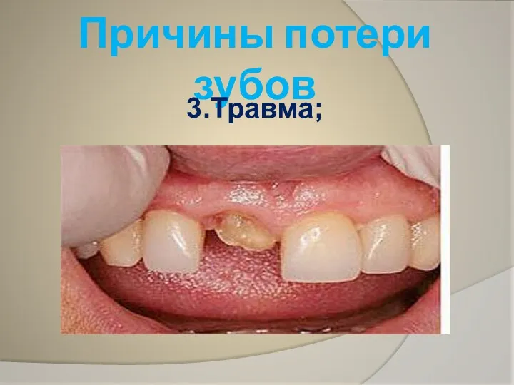 Причины потери зубов 3.Травма;
