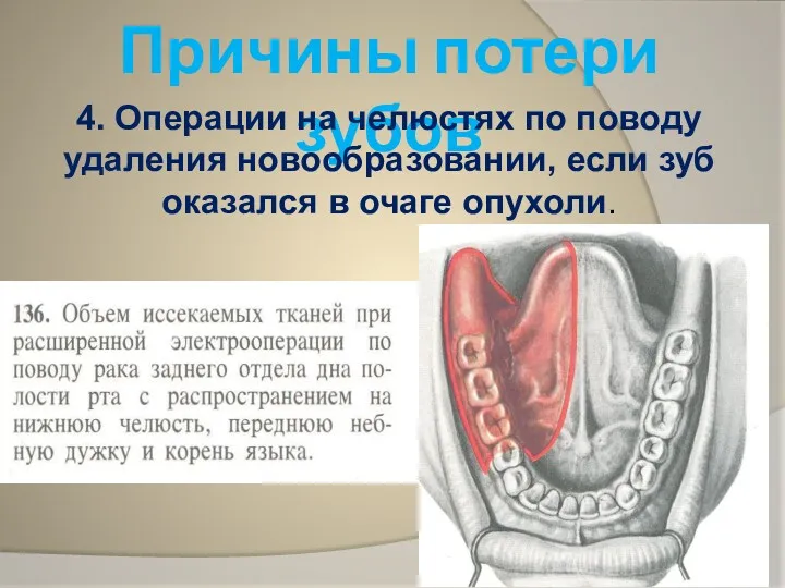 Причины потери зубов 4. Операции на челюстях по поводу удаления