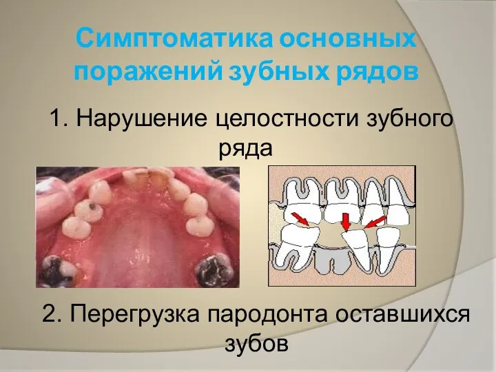 Симптоматика основных поражений зубных рядов 1. Нарушение целостности зубного ряда 2. Перегрузка пародонта оставшихся зубов