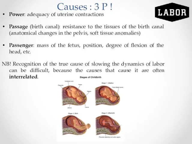 Causes : 3 P ! Power: adequacy of uterine contractions