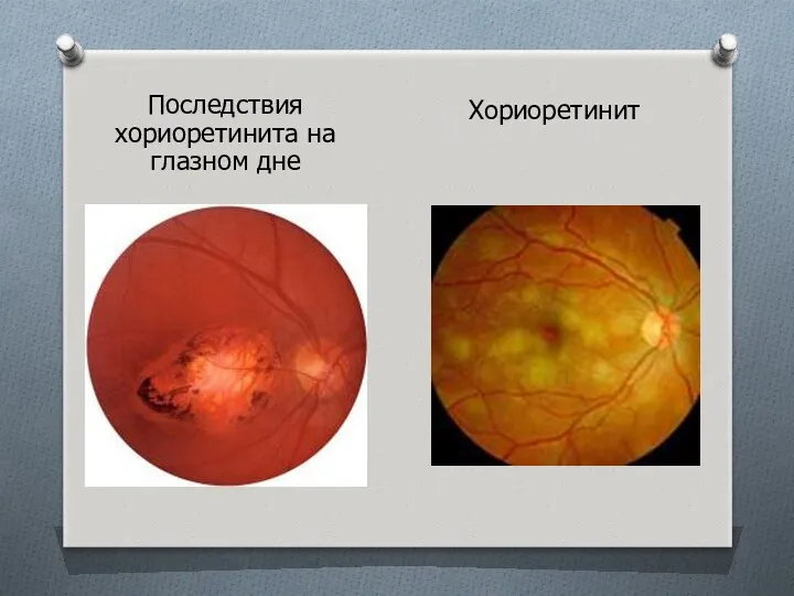 Последствия хориоретинита на глазном дне Хориоретинит