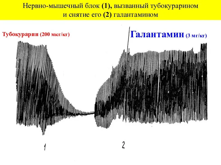 Нервно-мышечный блок (1), вызванный тубокурарином и снятие его (2) галантамином Тубокурарин (200 мкг/кг) Галантамин (3 мг/кг)