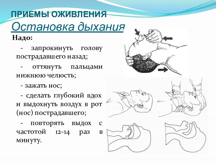 ПРИЕМЫ ОЖИВЛЕНИЯ Остановка дыхания Надо: - запрокинуть голову пострадавшего назад;