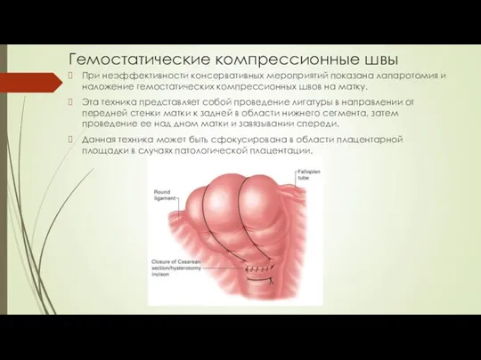 Гемостатические компрессионные швы При неэффективности консервативных мероприятий показана лапаротомия и наложение гемостатических компрессионных