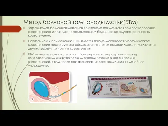 Метод баллоной тампонады матки(БТМ) Управляемая баллонная маточная тампонада применяется при послеродовых кровотечениях и
