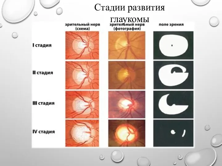 Стадии развития глаукомы