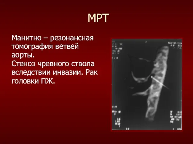 МРТ Манитно – резонансная томография ветвей аорты. Стеноз чревного ствола вследствии инвазии. Рак головки ПЖ.