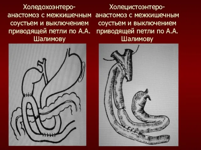 Холедохоэнтеро- анастомоз с межкишечным соустьем и выключением приводящей петли по